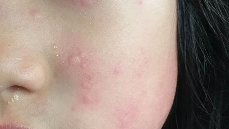 Một số người có thể bị dị ứng khi sử dụng vitamin C