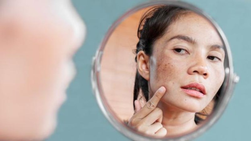 Sử dụng vitamin C giúp điều trị chứng tăng sắc tố