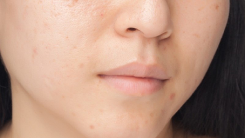 Vitamin C giúp giảm mẩn đỏ và đều màu da hơn