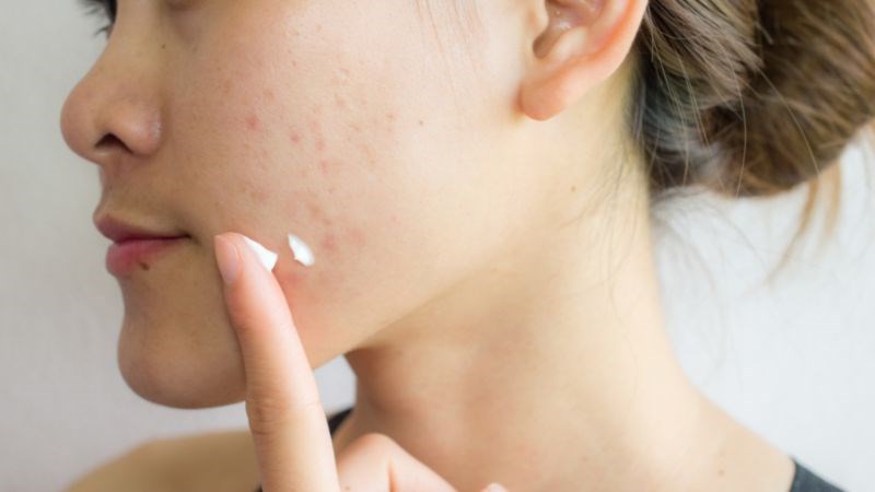 Dùng quá nhiều kem dưỡng ẩm sẽ khiến da bị bít tắc và nổi mụn