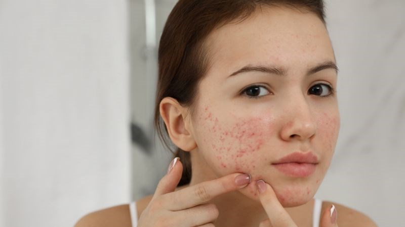 Làn da có thể bị nổi mụn khi bạn dùng kem dưỡng chứa cồn, hương liệu