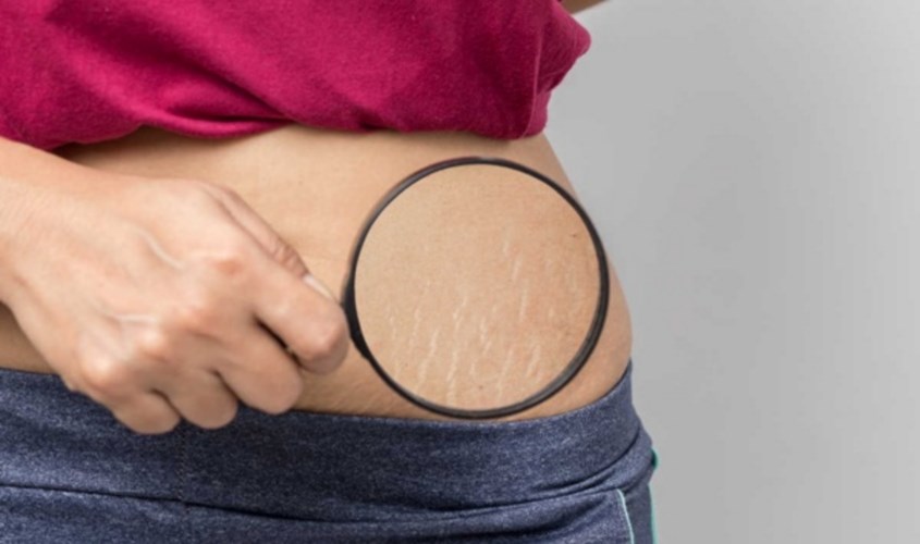 Vùng hông và eo là nơi dễ xuất hiện vết rạn