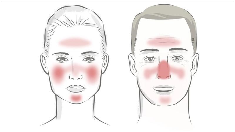 Đỏ mặt thường xuất hiện ở vùng mũi, má, cằm của bạn Đỏ mặt thường xuất hiện ở vùng mũi, má, cằm của bạn