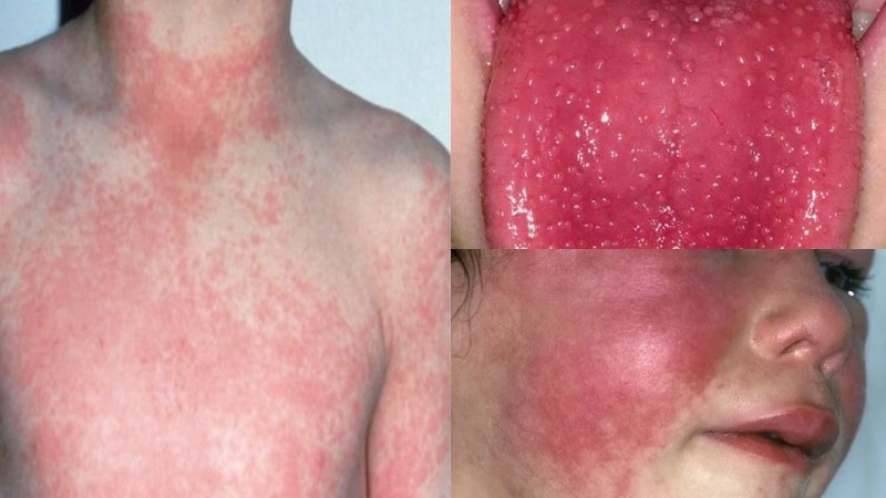 Bệnh tinh hồng nhiệt có thể gây đỏ da toàn thân bao gồm cả mặt Bệnh tinh hồng nhiệt có thể gây đỏ da toàn thân bao gồm cả mặt