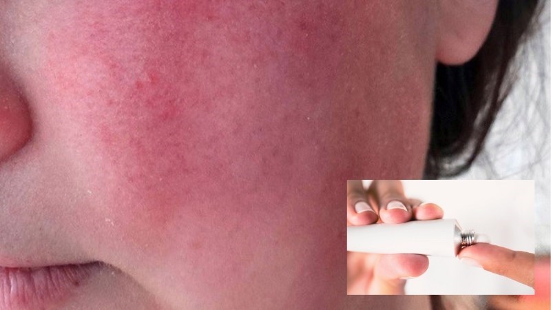 Các thuốc bôi có thể được sử dụng để làm giảm triệu chứng đỏ mặt của bạn Các thuốc bôi có thể được sử dụng để làm giảm triệu chứng đỏ mặt của bạn