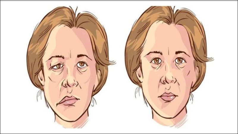 Mã tiền được dùng trong 2 bài thuốc điều trị liệt mặt