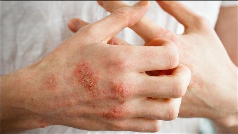 Hỗn hợp dầu vừng và mã tiền dùng bôi lên vùng da bị ghẻ, hủi để điều trị