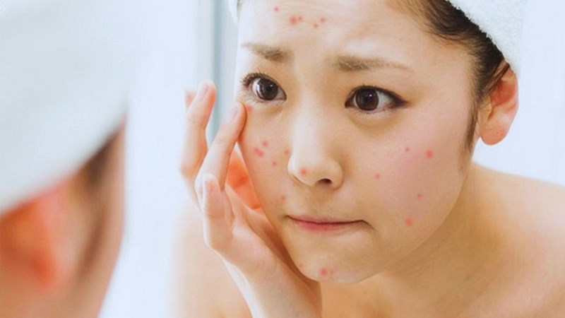 Dùng kem chống nắng không phù hợp với da có thể khiến da kích ứng nổi mụn