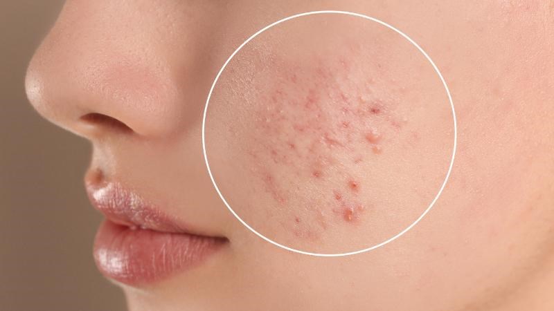 Nên dùng kem chống nắng ngay cả khi bị mụn