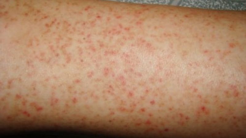 Sốt xuất huyết là bệnh truyền nhiễm gây sốt cao và ban xuất huyết dưới da