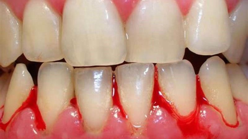 Giảm tiểu cầu gây tình trạng xuất huyết từ nhẹ đến nặng