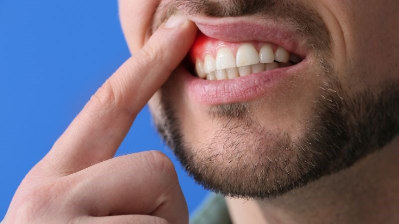 Viêm lợi là một bệnh răng miệng phổ biến và có thể gây nhiều biến chứng nguy hiểm