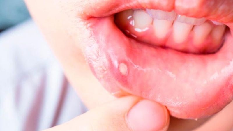 Viêm loét niêm mạc miệng thường xuất hiện trong các đợt dùng hóa chất
