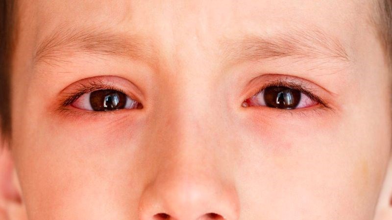 Một trong những biến chứng nghiêm trọng của bệnh lậu là đỏ và chảy nhiều nước mắt
