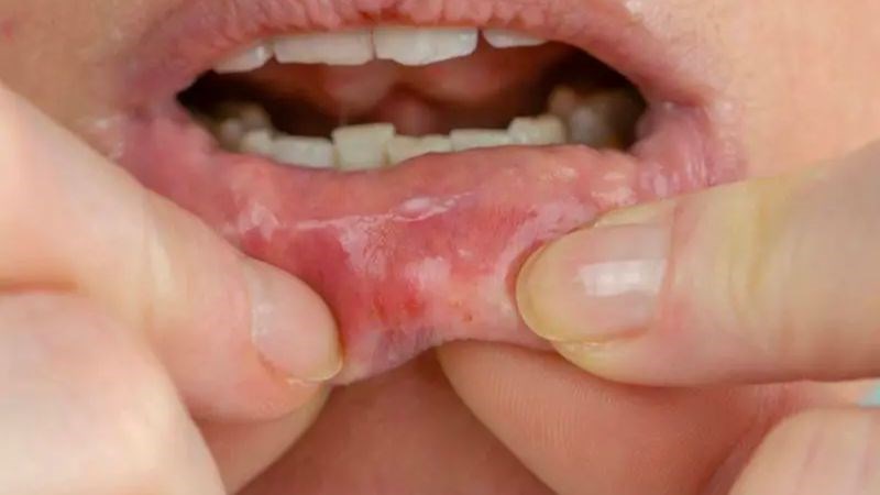 Bệnh lậu có thể lây truyền qua việc quan hệ tình dục bằng miệng