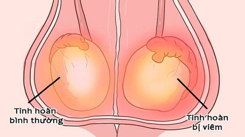Tinh hoàn bị viêm nhiễm sẽ trở nên đỏ, sưng to khi bị bệnh lậu
