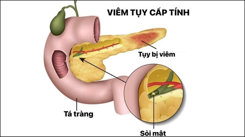 Rượu bia sẽ gây kích hoạt các enzyme bất thường tiêu hóa ở trong tuyến tụy.