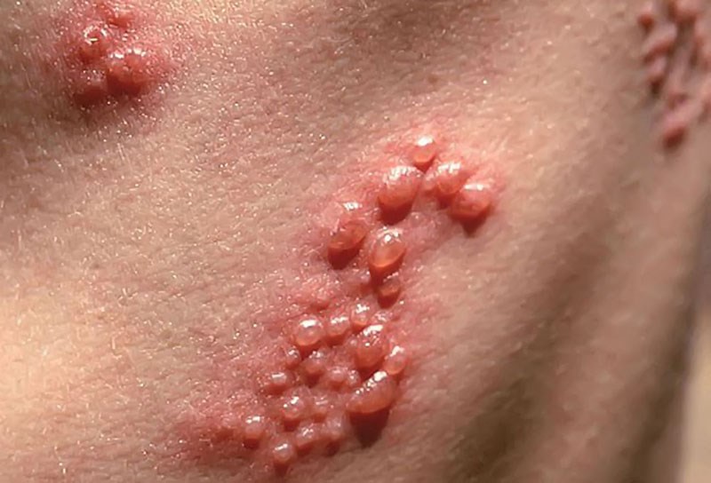 Với đặc tính kháng virus, tinh dầu hương thảo giúp giảm sự lây nhiễm của virus herpes