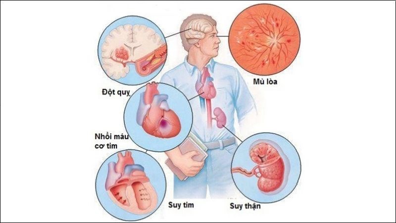 Cao huyết áp có thể làm tổn thương nghiêm trọng các cơ quan quan trọng