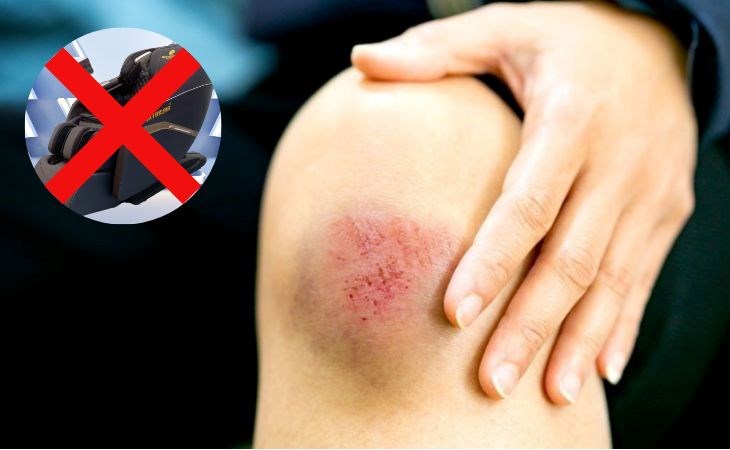 Bề mặt ghế không được vệ sinh thường xuyên sẽ làm vết thương hở bị nhiễm trùng