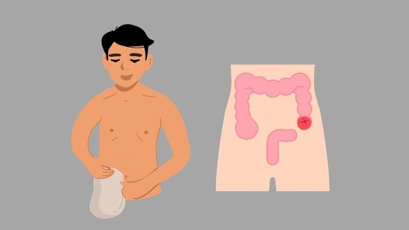 Hậu môn nhân tạo là một lỗ thông từ ruột ra ngoài ra bụng