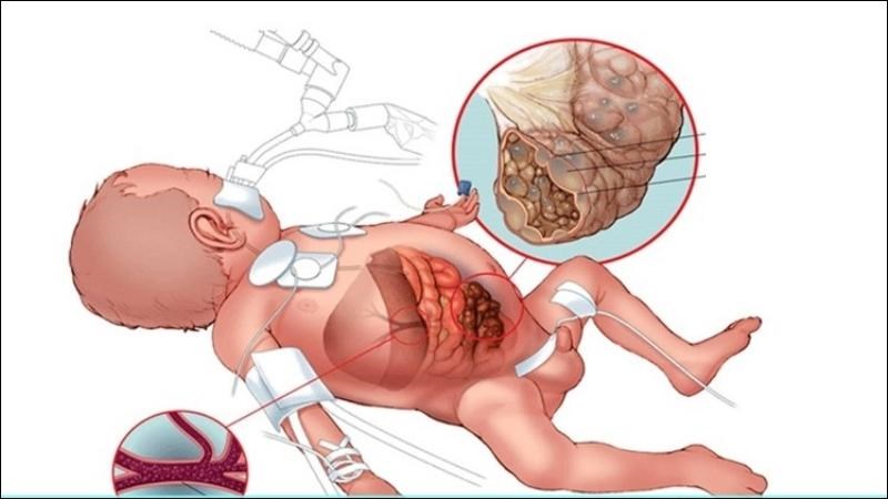 Viêm ruột hoại tử ở trẻ em có thể dẫn đến việc đặt hậu môn nhân tạo vĩnh viễn