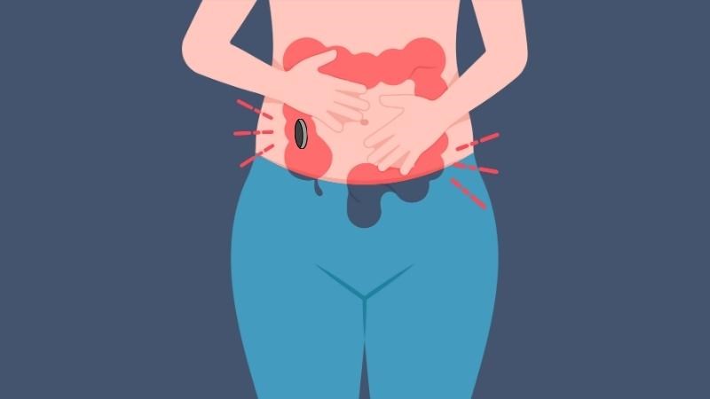 Hậu môn nhân tạo có thể được chỉ định khi thủng ruột với vết thủng lớn nhưng khu trú