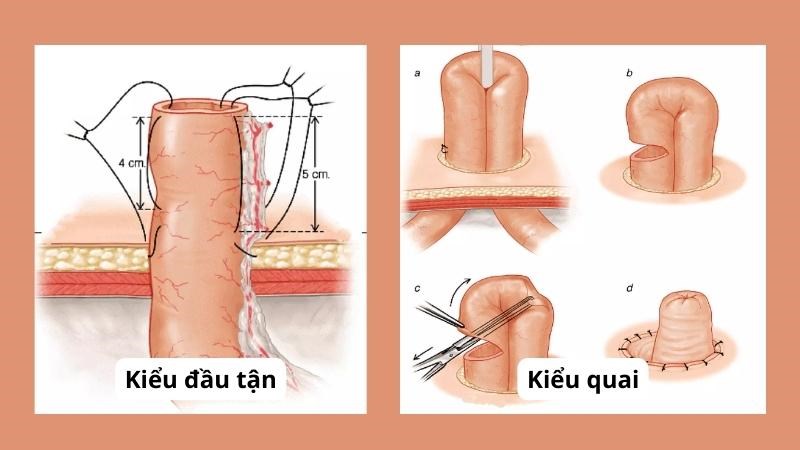 Hậu môn nhân tạo kiểu đầu tận và kiểu quai