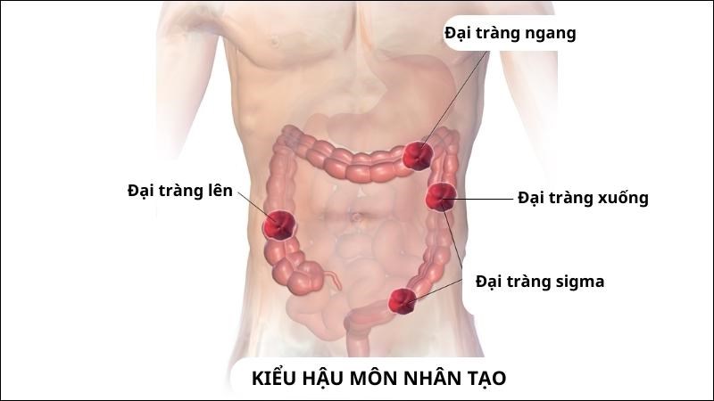 Các vị trí của hậu môn nhân tạo tại đại tràng