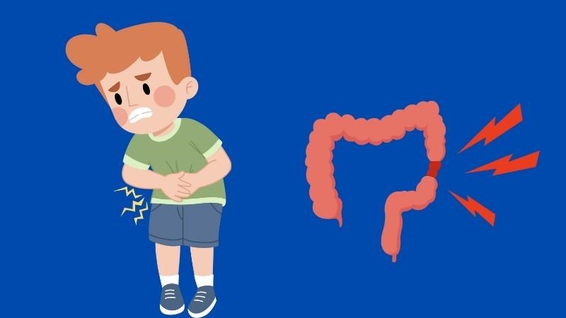 Một số trường hợp dị dạng đường ruột bẩm sinh phải cần đặt hậu môn nhân tạo