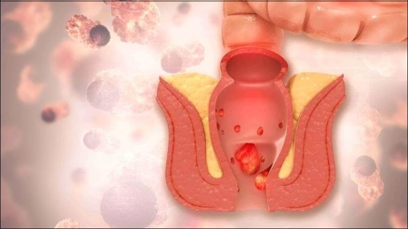 Tr&agrave; hoa h&ograve;e c&oacute; t&aacute;c dụng gi&uacute;p điều trị c&aacute;c triệu chứng của bệnh trĩ