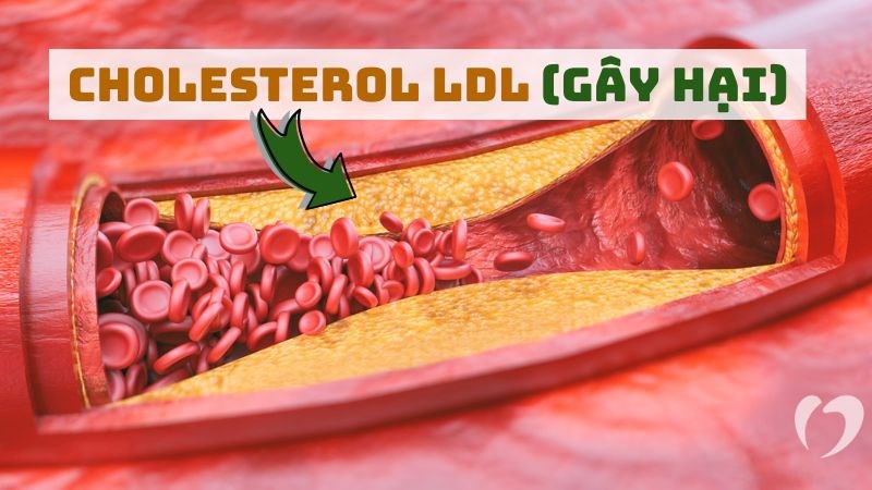 Các chất chống oxy hóa trong chuối giúp giảm nồng độ cholesterol LDL có hại