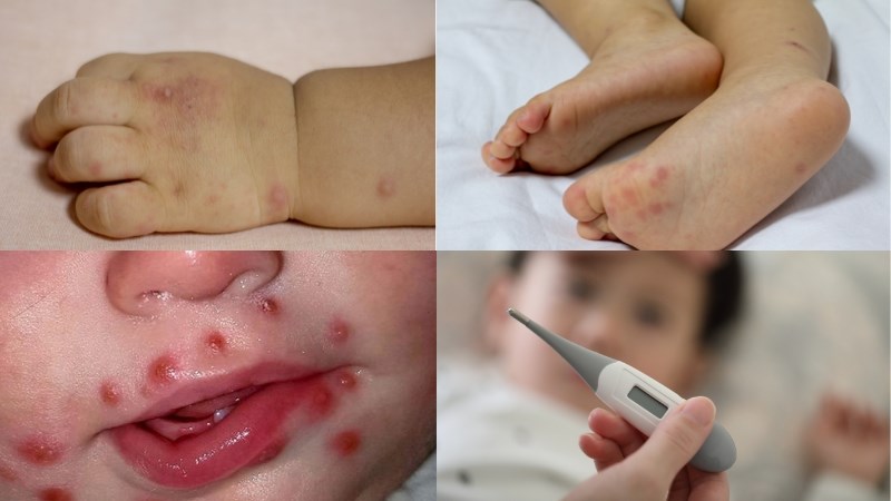 Các triệu chứng điển hình của tay chân miệng trẻ em
