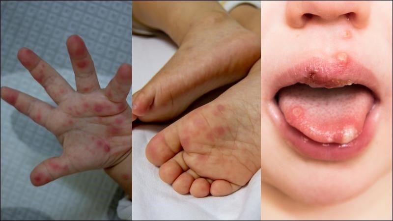 Bệnh tay chân miệng độ một chỉ gây ra vết loét ở miệng và/hoặc tổn thương da