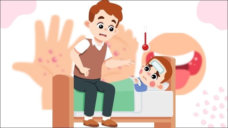 Bệnh tay chân miệng độ 1 chỉ cần điều trị tại nhà và theo dõi tại y tế cơ sở