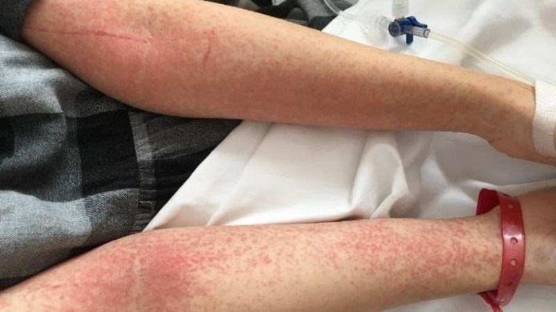 Ăn nhiều nấm kim châm có thể gây ra các phản ứng dị ứng như ngứa, đỏ
