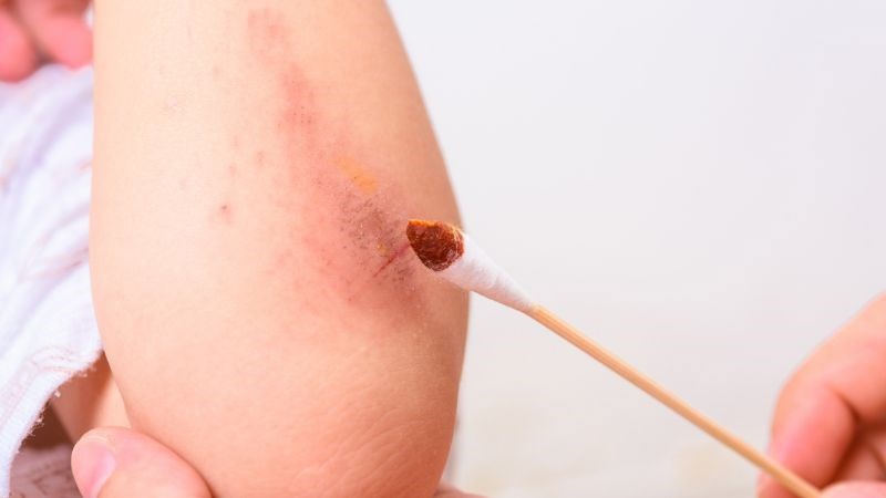 Sát trùng bằng cồn sẽ giúp tiêu diệt vi khuẩn xâm nhập