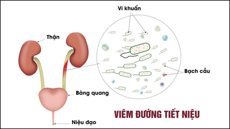 Viêm đường tiết niệu là do vi khuẩn xâm nhập và gây viêm ở đường tiết niệu