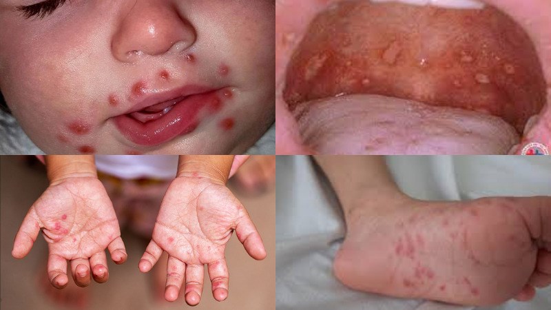 Vết loét ở miệng, phát ban trên cơ thể là các triệu chứng điển hình của tay chân miệng