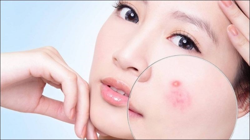 Ăn nhiều socola đen có thể gây ra mụn trứng cá