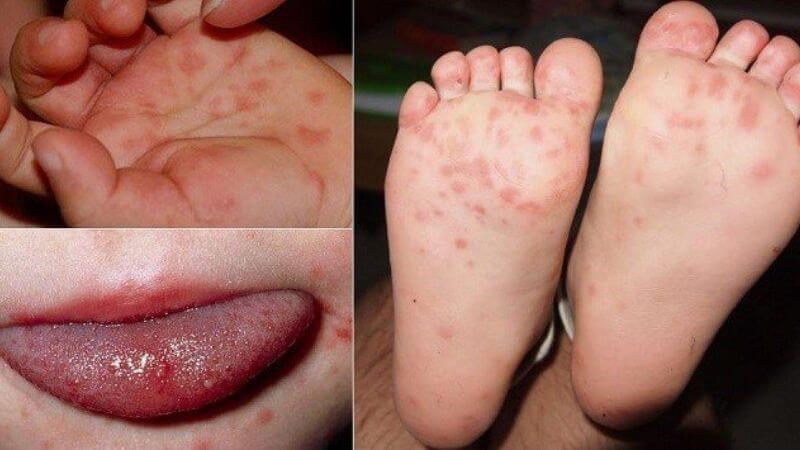Phát ban không được chăm sóc tốt có thể gây ngứa cho trẻ