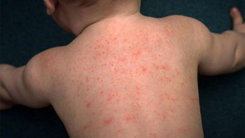 Trẻ có thể bị kích ứng da nếu sử dụng thuốc không rõ nguồn gốc