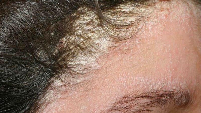 Vùng đầu cũng là nơi dễ gây bít tắc nhất và cần được tẩy trang cẩn thận Vùng đầu cũng là nơi dễ gây bít tắc nhất và cần được tẩy trang cẩn thận