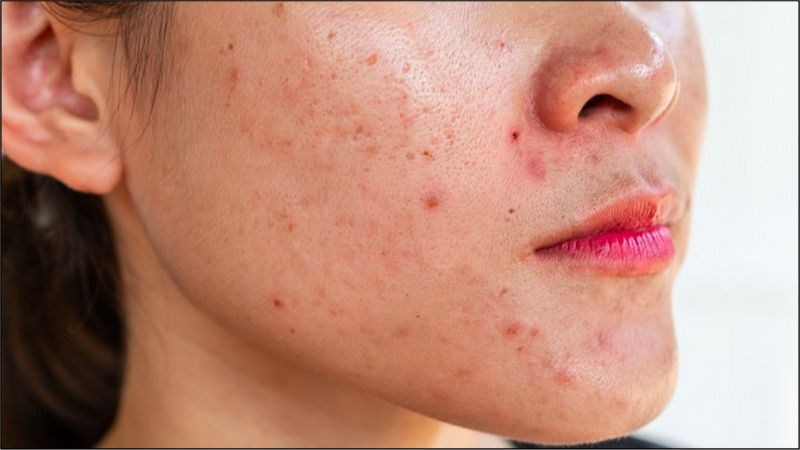 Tình trạng viêm nhiễm tiến triển khi lớp trang điểm làm bít tắc các lỗ chân lông Tình trạng viêm nhiễm tiến triển khi lớp trang điểm làm bít tắc các lỗ chân lông