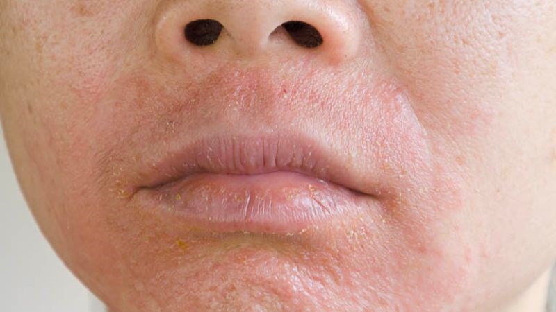 Lớp mỹ phẩm sẽ làm da mất đi độ ẩm, gây bong tróc Lớp mỹ phẩm sẽ làm da mất đi độ ẩm, gây bong tróc