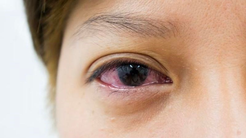 Viêm kết mạc là tình trạng thường hay xảy ra do các hoá chất có trong mỹ phẩm Viêm kết mạc là tình trạng thường hay xảy ra do các hoá chất có trong mỹ phẩm