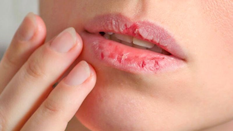 Tình trạng nứt nẻ môi thường xảy ra khi lớp son môi không được tẩy kỹ Tình trạng nứt nẻ môi thường xảy ra khi lớp son môi không được tẩy kỹ