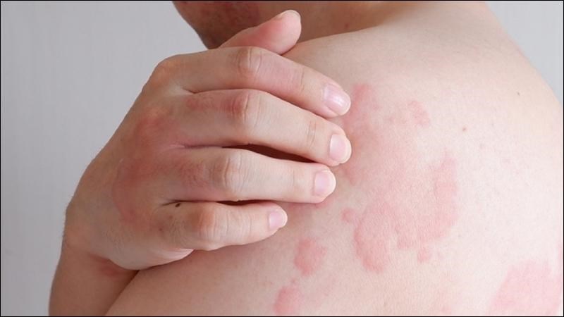 Dùng tinh dầu sả chanh nồng độ cao có thể gây kích ứng da và nổi mẩn ngứa