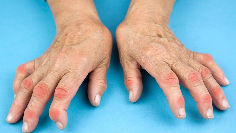 Tinh dầu sả chanh giúp giảm đau, sưng đỏ các khớp tổn thương trong thấp khớp
