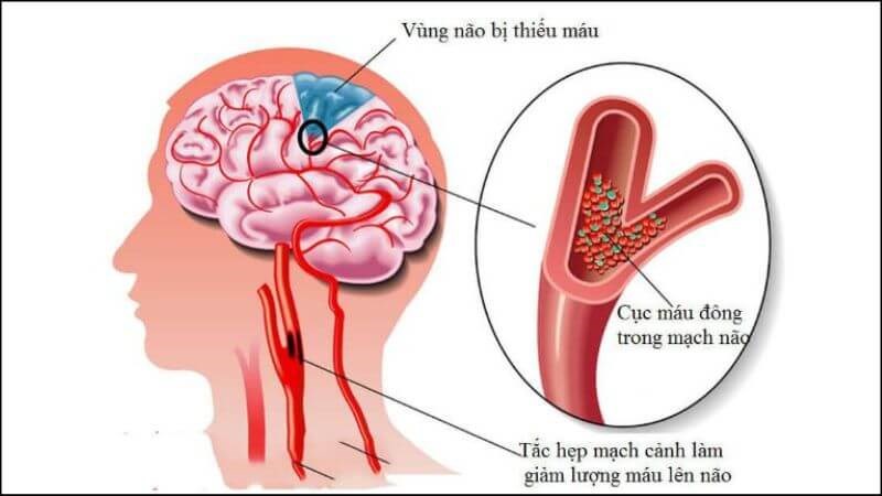 Khí huyết bị mất cân bằng sẽ gây ra sự tắc nghẽn, vì vậy gây ra rối loạn về thần kinh